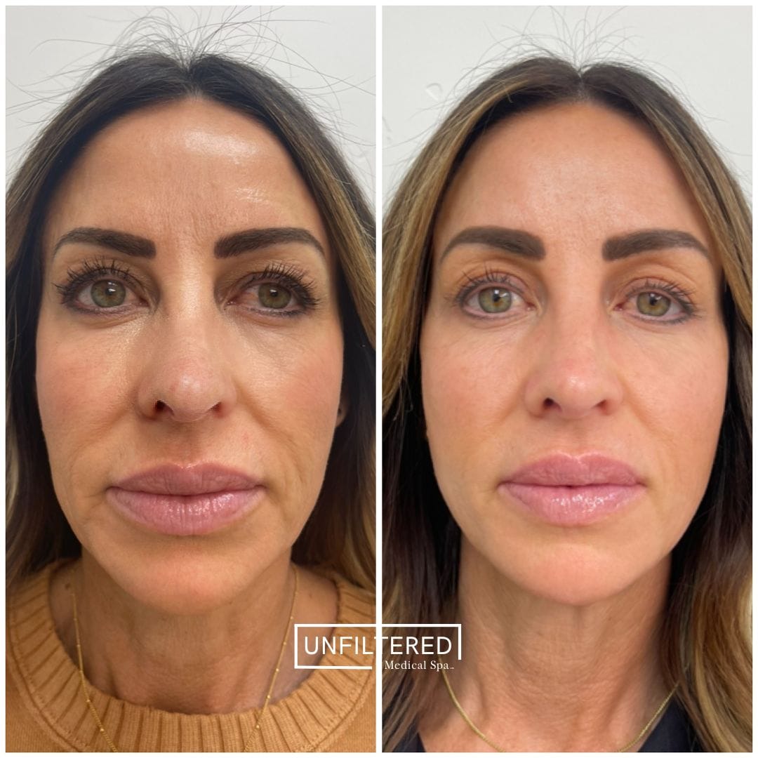 FACIAL HARMONIZATION BEFORE AND AFTERS | unfiltered MEDICAL SPA | South Jordan, Utah