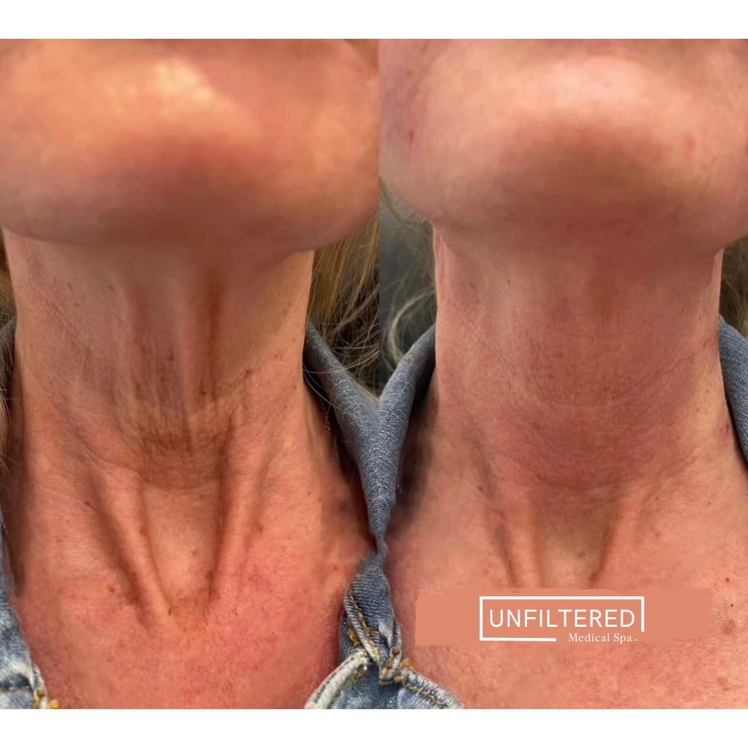 NON-SURGICAL FACELIFT | unfiltered MEDICAL SPA | South Jordan, Utah