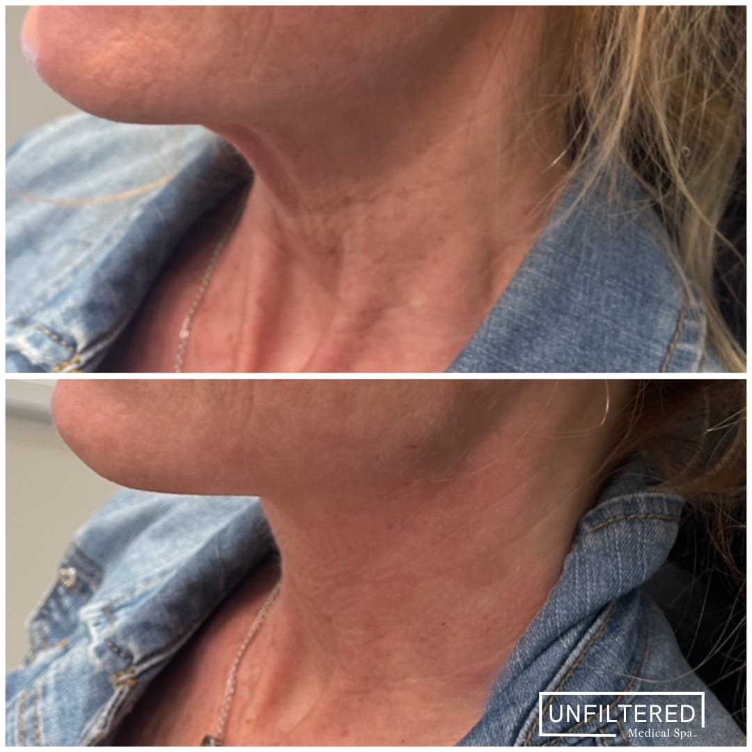 NON-SURGICAL FACELIFT | unfiltered MEDICAL SPA | South Jordan, Utah