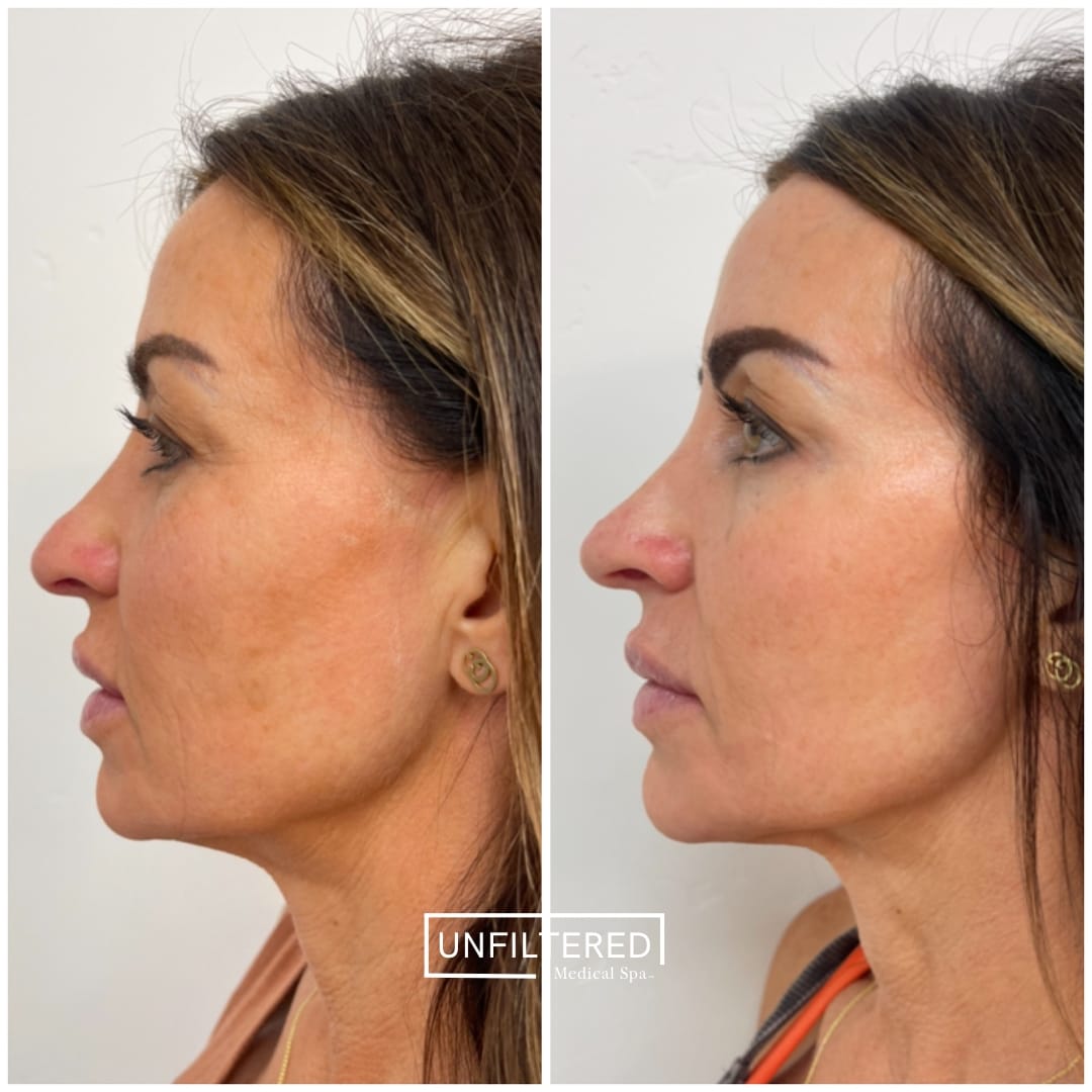 FACIAL BALANCING | unfiltered MEDICAL SPA | South Jordan, Utah