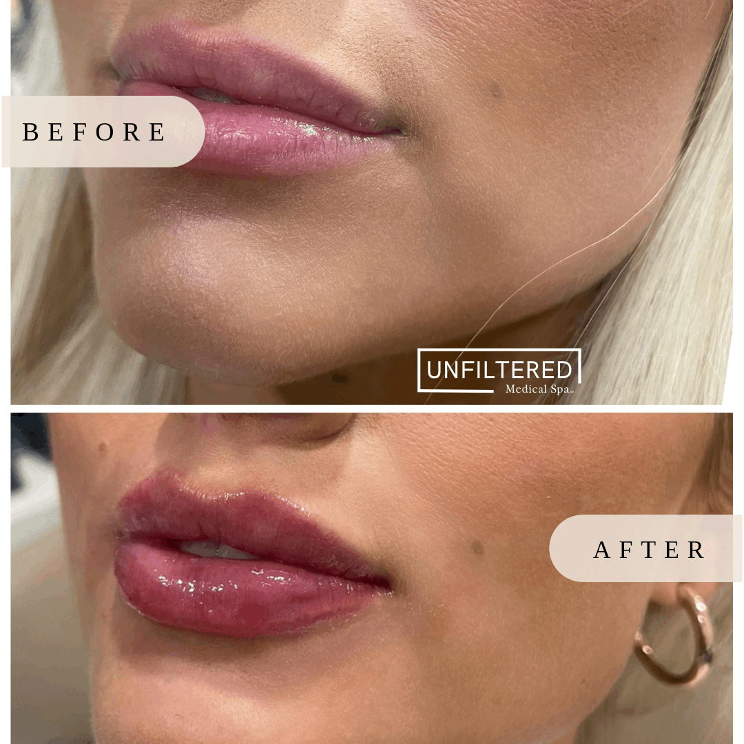 lips filler aftercare | unfiltered MEDICAL SPA | South Jordan, Utah