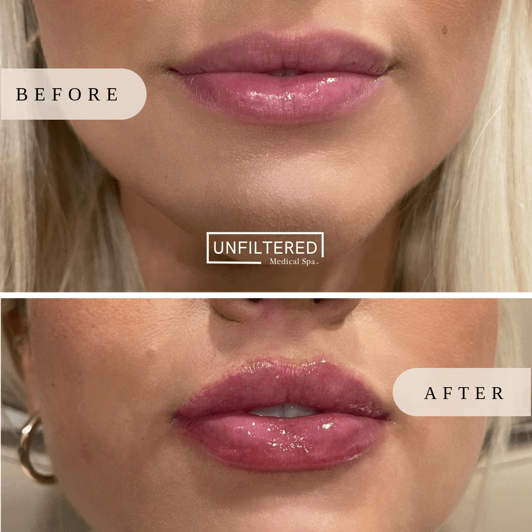 Lip injection: after care | unfiltered MEDICAL SPA | South Jordan, Utah