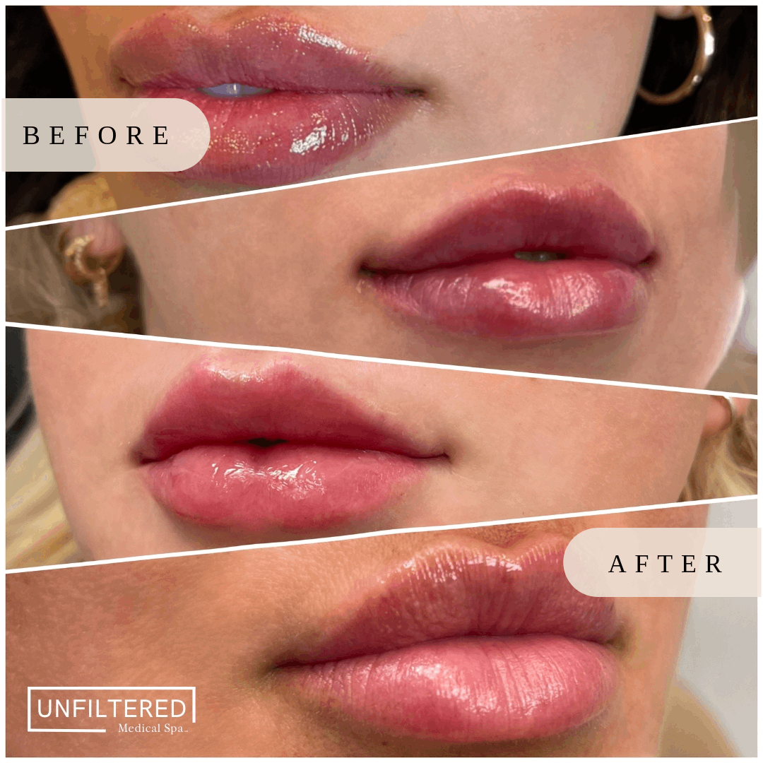 Lip Filler Before & After Photo | unfiltered MEDICAL SPA | South Jordan, Utah