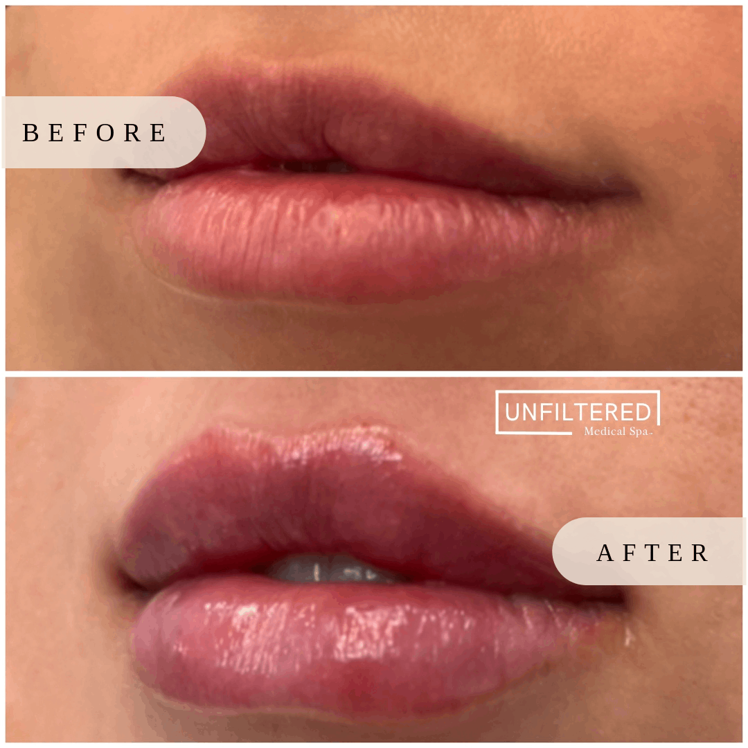 My Lips Feel After Lip Fillers | unfiltered MEDICAL SPA | South Jordan, Utah