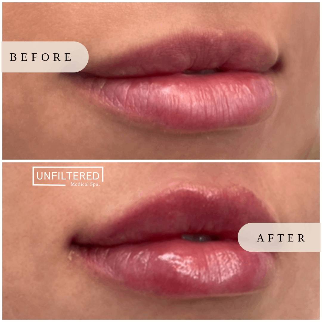 Lips after Lip filler injections | unfiltered MEDICAL SPA | South Jordan, Utah