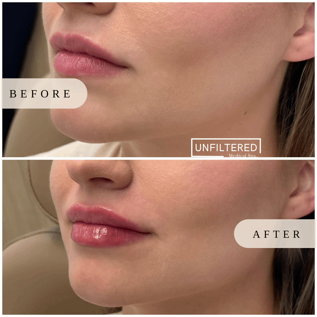 Your Lips after dermal filler | unfiltered MEDICAL SPA | South Jordan, Utah