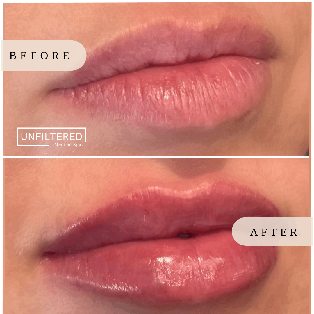 Lips after Lip filler injections | unfiltered MEDICAL SPA | South Jordan, Utah