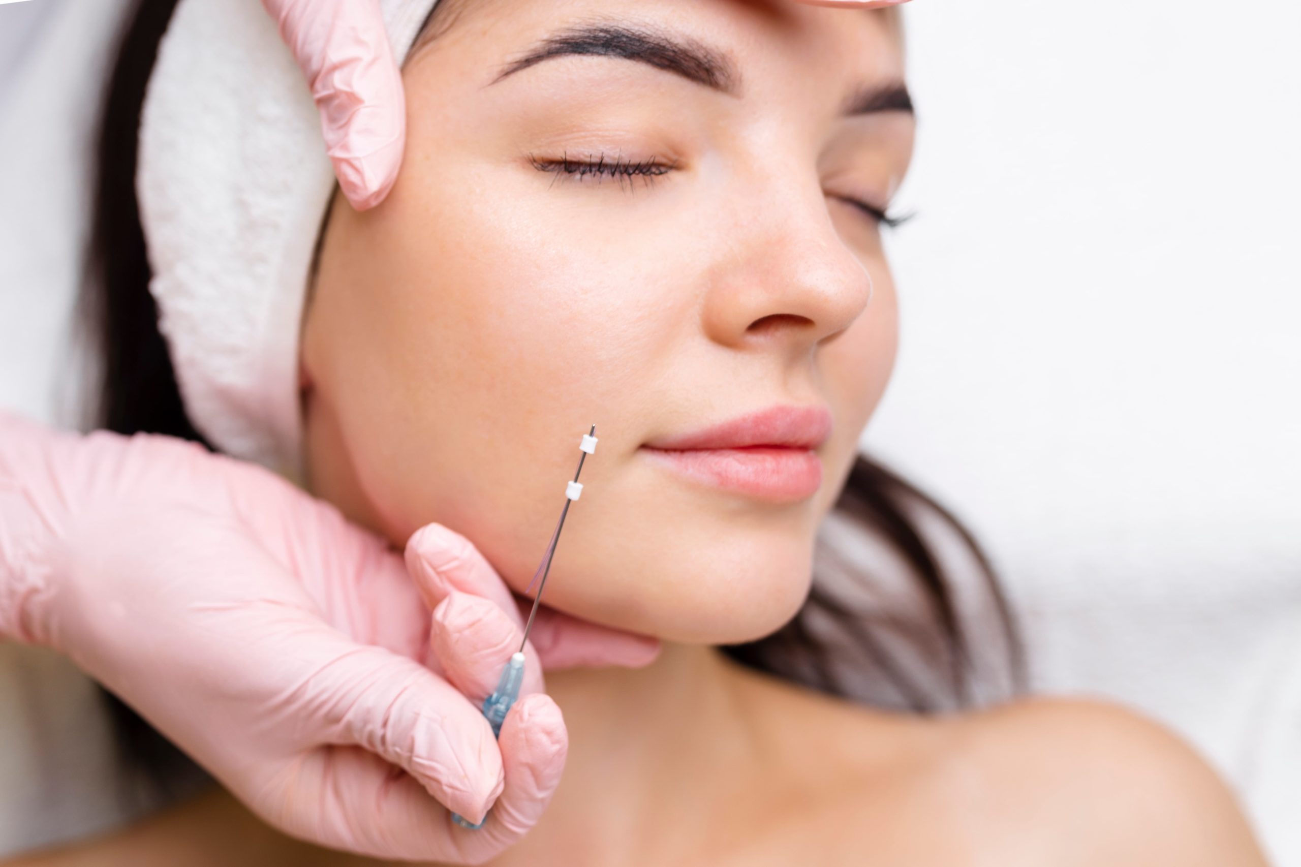 PDO Threads for Facial Rejuvenation at Unfiltered Medical Spa
