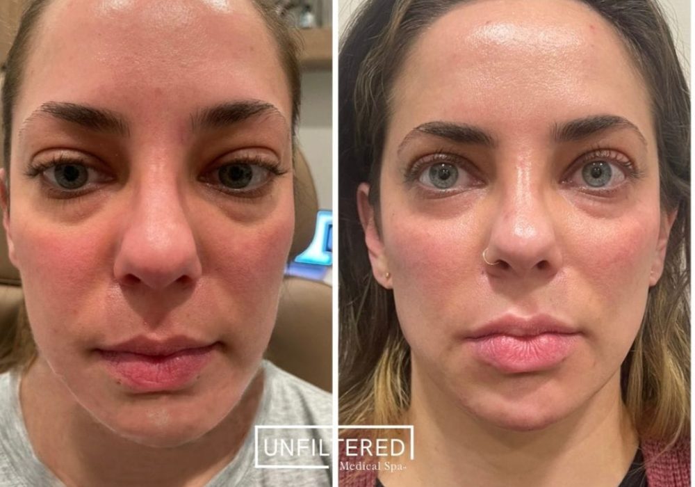FACIAL HARMONIZATION BEFORE AND AFTERS | unfiltered MEDICAL SPA | South Jordan, Utah